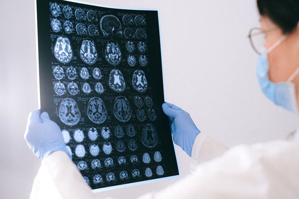 delayed concussion symptoms